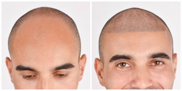 Client B before and after micropigmentation
