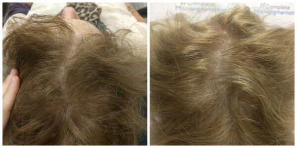 Kristin top Before and After scalp micropigmentation