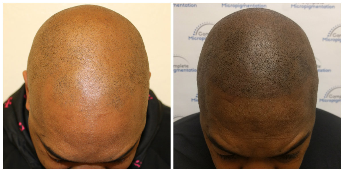 Maurice front Before and After scalp micropigmentation