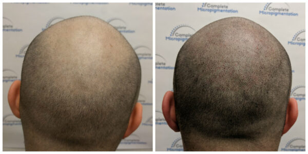 Ig back - before and after scalp micropigmentation by Complete Micropigmentation
