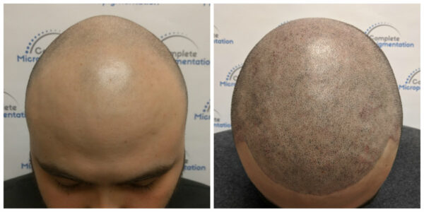 Ig top - before and after scalp micropigmentation by Complete Micropigmentation