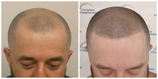 ao front - before and after scalp micropigmentation by Complete Micropigmentation